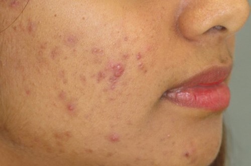 acne-and-pimples