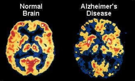 memory-loss-and-alzheimers-dementia