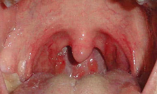 tonsils-and-throat-infection
