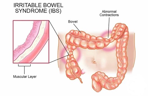 irritable-bowel-syndrome
