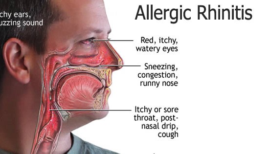 allergic-rhinitis