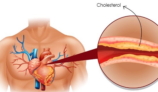 cholesterol