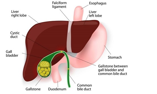 gall-bladder-stones
