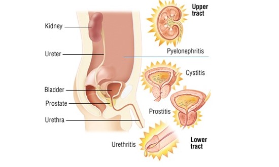 urinary-tract-infection-male