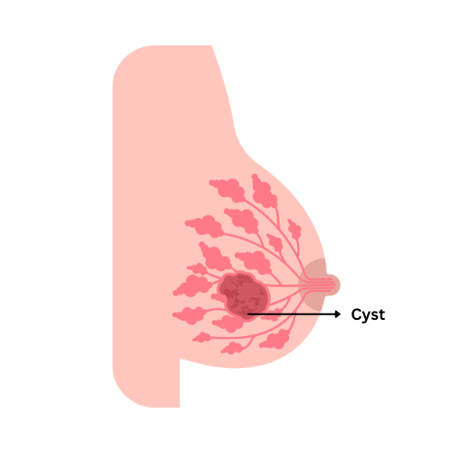 How to cure breast lump naturally?